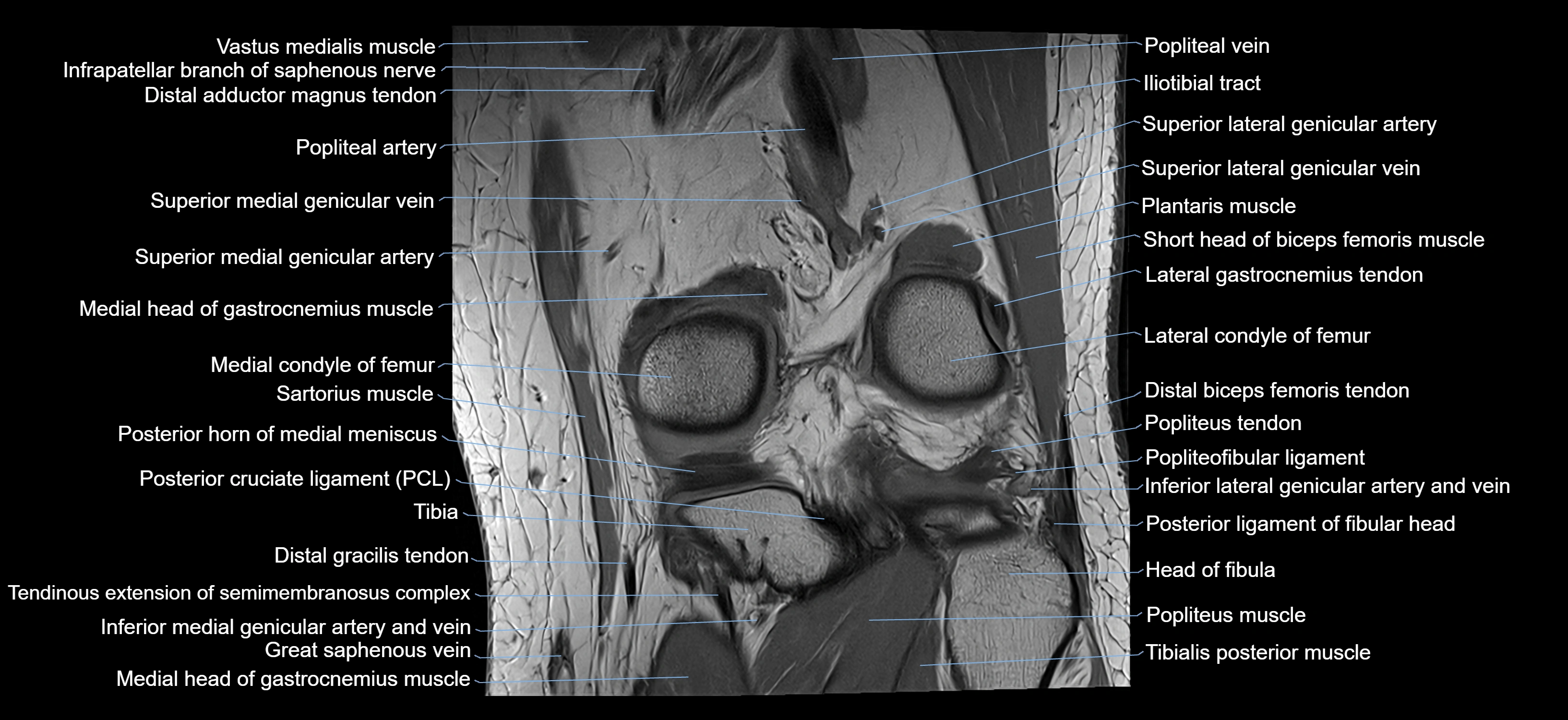 MRI knee coronal cross sectional anatomy labelled 3T radiology  image-04001-00028.webp